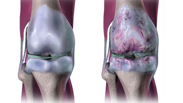 Articolazione del ginocchio sana e affetta da artrosi