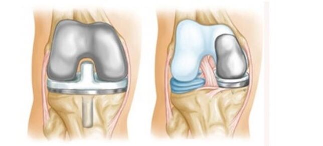 artroplastica per l'artrosi dell'articolazione del ginocchio