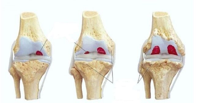 fasi di artrosi dell'articolazione del ginocchio