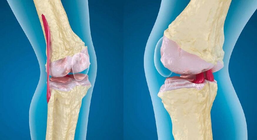 articolazione sana e artrosi dell'articolazione del ginocchio