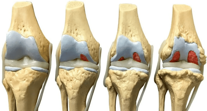 danno all'articolazione del ginocchio in diverse fasi dello sviluppo dell'artrosi