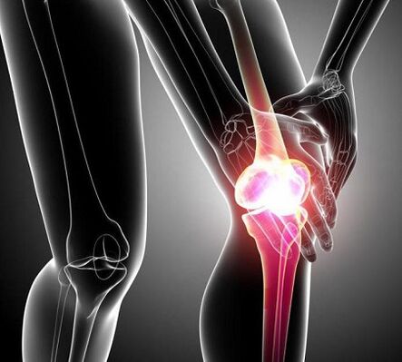 danno all'articolazione del ginocchio con artrite e artrosi