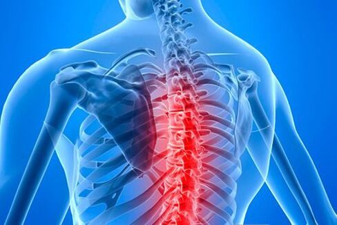 lesione spinale in caso di osteocondrosi toracica