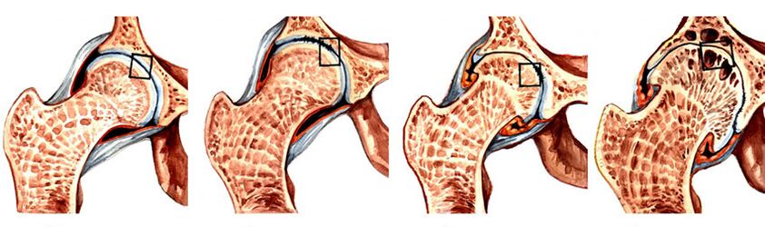 Il grado di sviluppo dell'artrosi dell'articolazione dell'anca