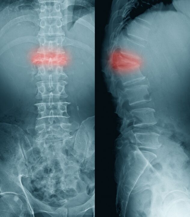 diagnosi del mal di schiena