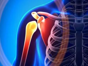 Articolazione della spalla infiammata a causa dell'artrosi - una malattia cronica del sistema muscolo-scheletrico