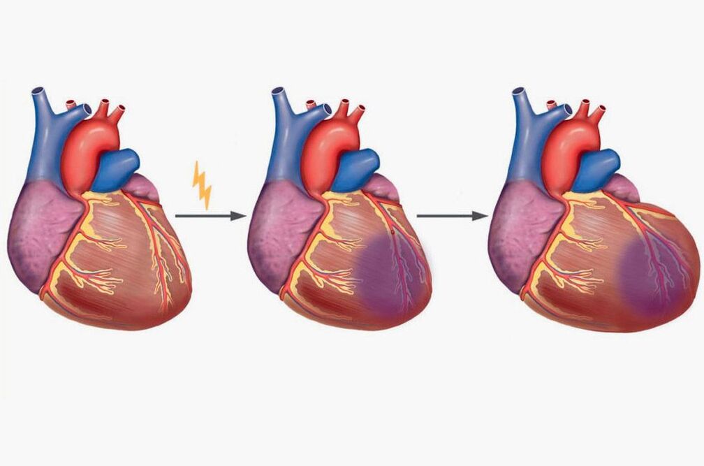 L'infarto del miocardio porta a dolore alle scapole