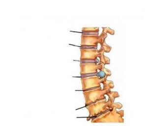Sintomi di osteocondrosi