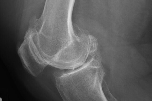 Metodi per diagnosticare l'artrosi del ginocchio