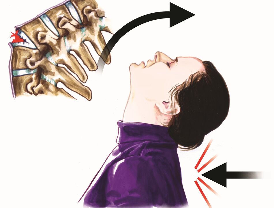 danno spinale come causa di dolore al collo