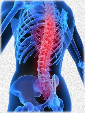 osteocondrosi e metodi del suo trattamento